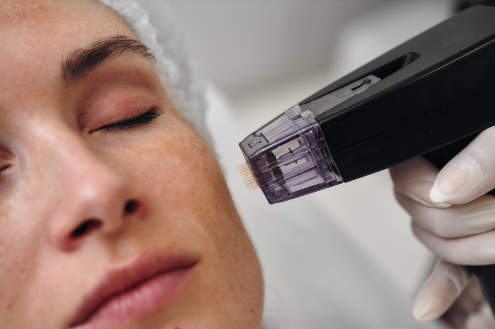 Woman,receiving,microneedling,treatment,in,a,skincare,clinic