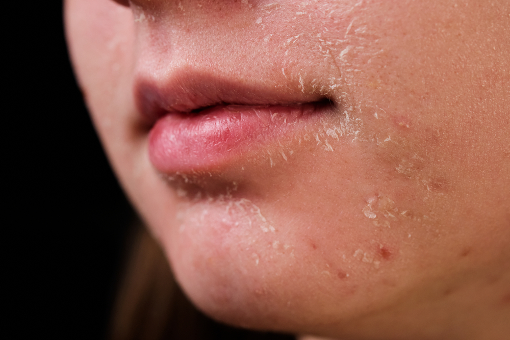 Flaky,skin,of,a,girl,after,cosmetic,procedures