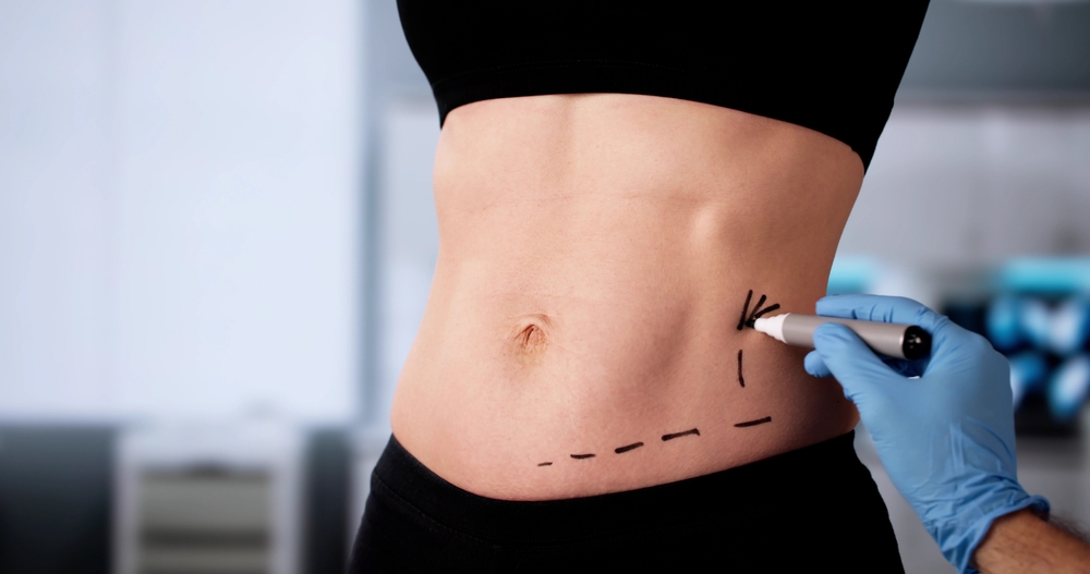 Professional,surgeon,performing,liposuction,surgery,on,obese,woman's,abdominal,area.