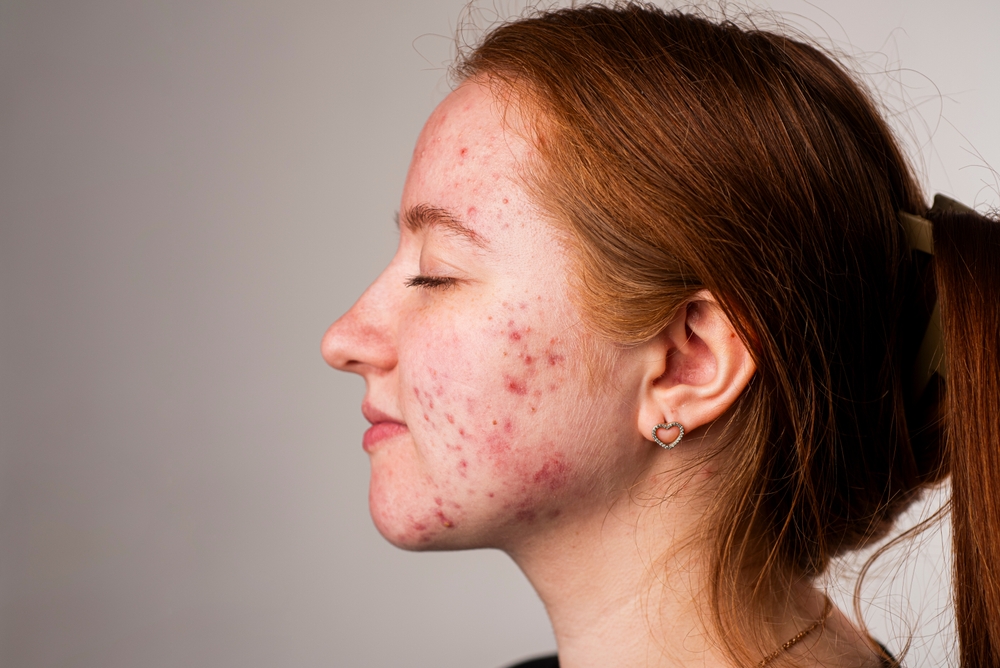 Many,pimples.,girl,with,bad,skin.,hormonal,acne,,puberty.,skin