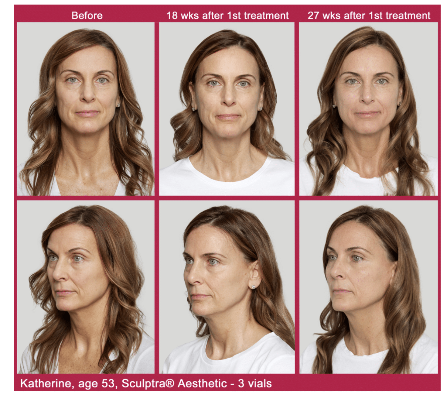 Biostimulators are Redefining Non-Surgical Beauty Treatments
