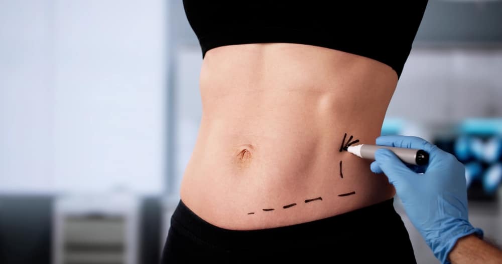 Professional,surgeon,performing,liposuction,surgery,on,obese,woman's,abdominal,area.