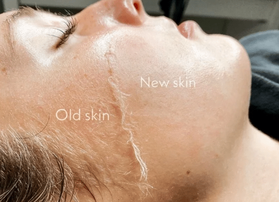 Dermaplaning