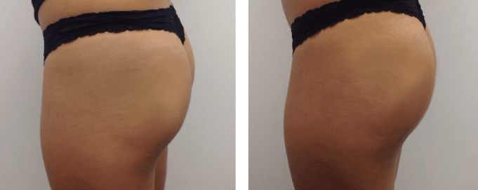Sculptra Booty