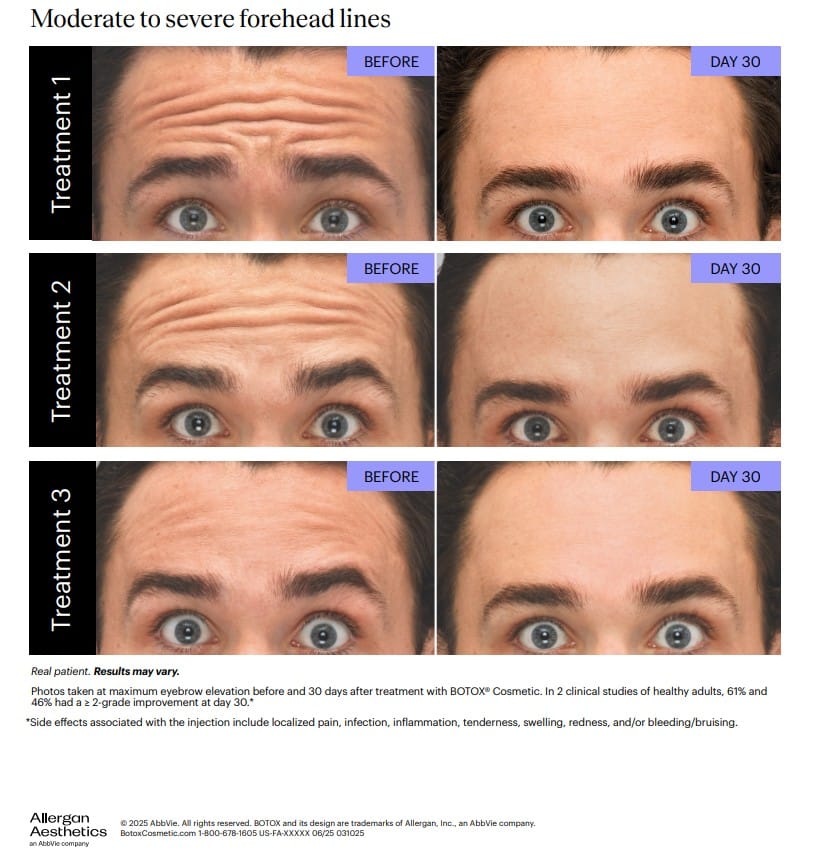 Forehead
