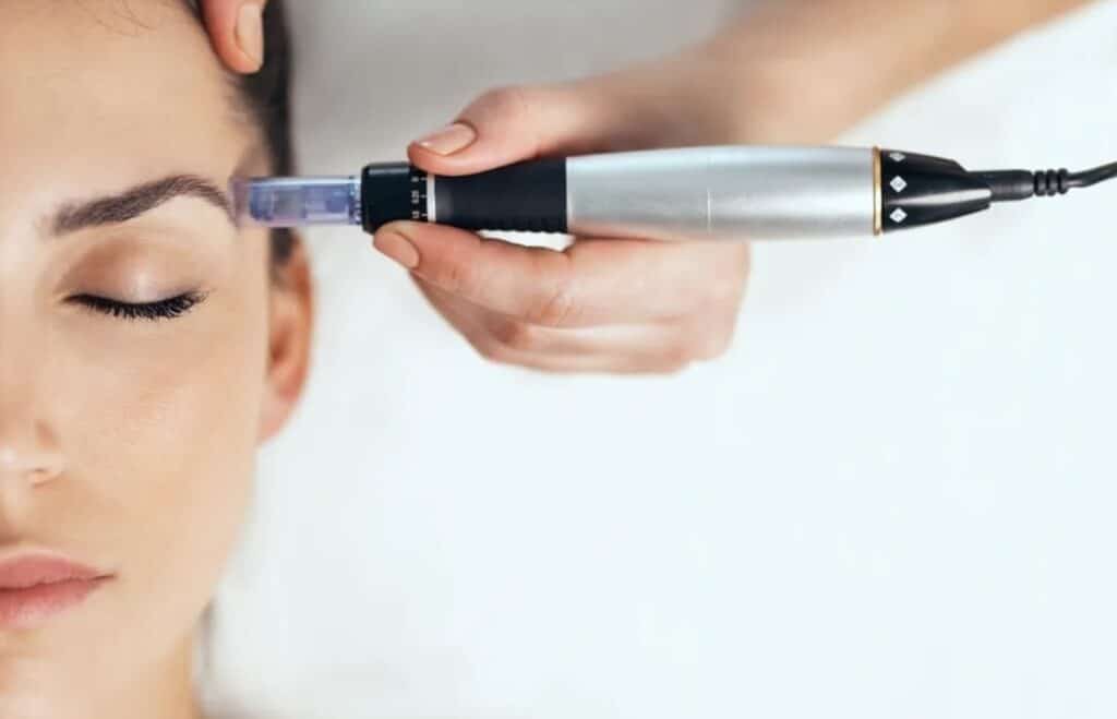 Microneedling