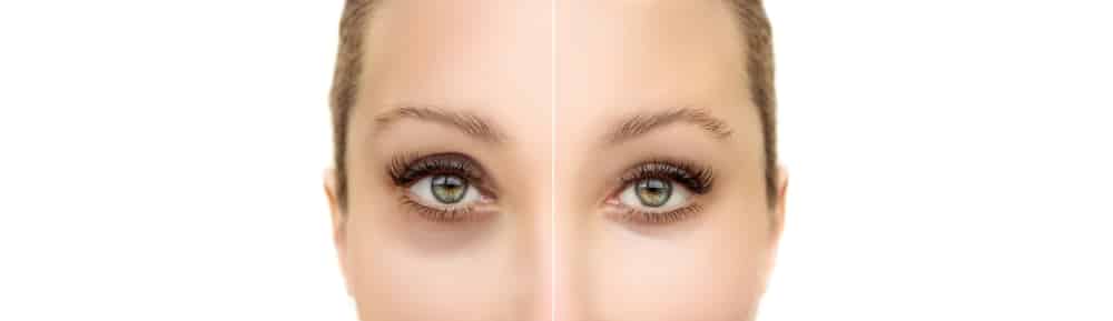 Tear,trough,filler,a Frame,deformity.,fat,grafting,or,dermal,filler,treatments