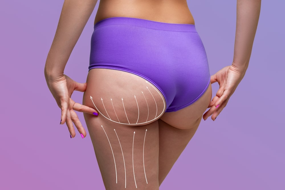 Buttocks,liposuction,,fat,and,cellulite,removal,concept,,overweight,female,body