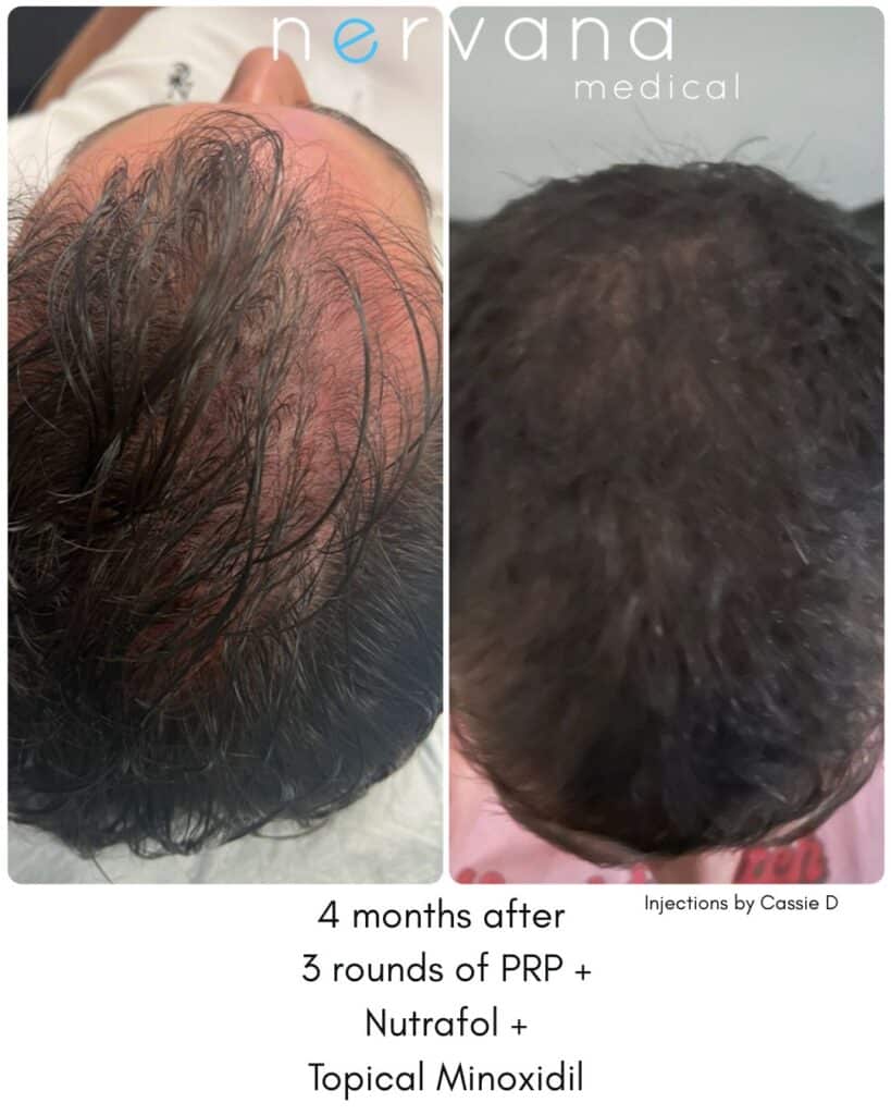 Hair Loss Treatment in Sandy, UT: What the Evidence Actually Says