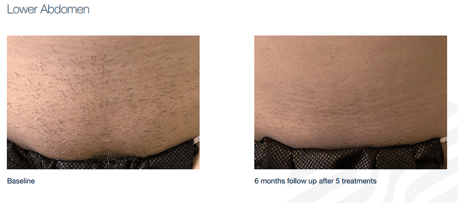458e0d_0d21618054b64eadabb147677ae21907mv2 Laser Hair Removal in Sandy, UT