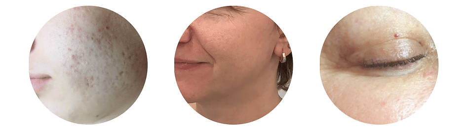 458e0d_616353a7e4fb4a28a768f5556af0b0b0mv2 Laser Hair Removal in Sandy, UT