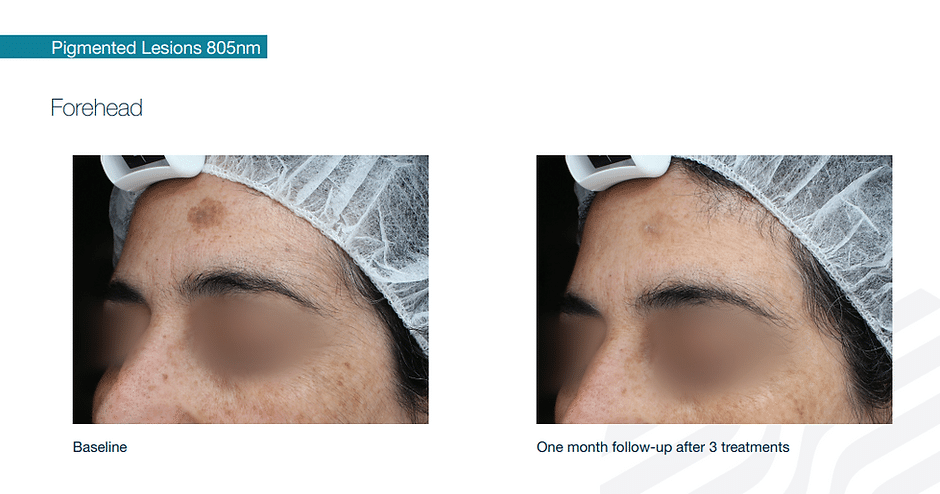 458e0d_6523381844d4466cae21e96ecd7dca50mv2 Laser Hair Removal in Sandy, UT