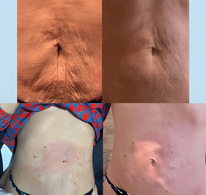 458e0d_71dd3754292345d881bd6cf67a2e5fe3mv2_upscayl_2x_upscayl-standard-4x Morpheus8 & Microneedling in Sandy, UT