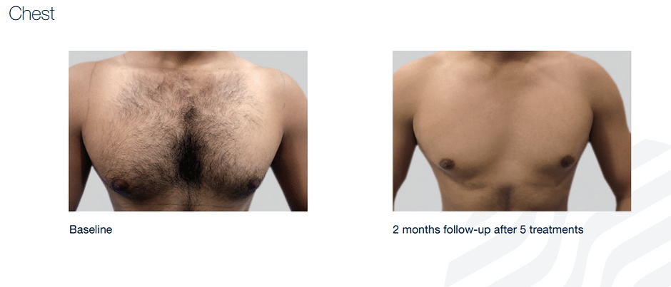 458e0d_81d3569ff98f4309ab46b32d30463c8amv2 Laser Hair Removal in Sandy, UT