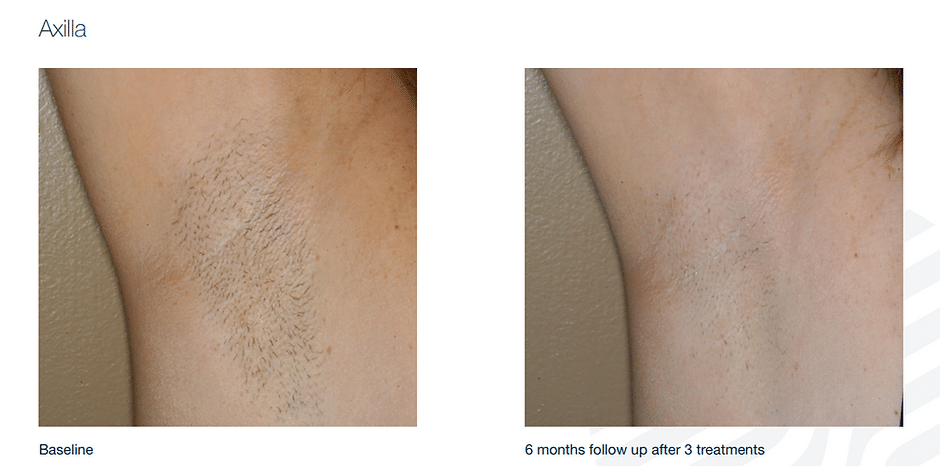 458e0d_883bdc16b0a74263bf8499c0c460c093mv2 Laser Hair Removal in Sandy, UT