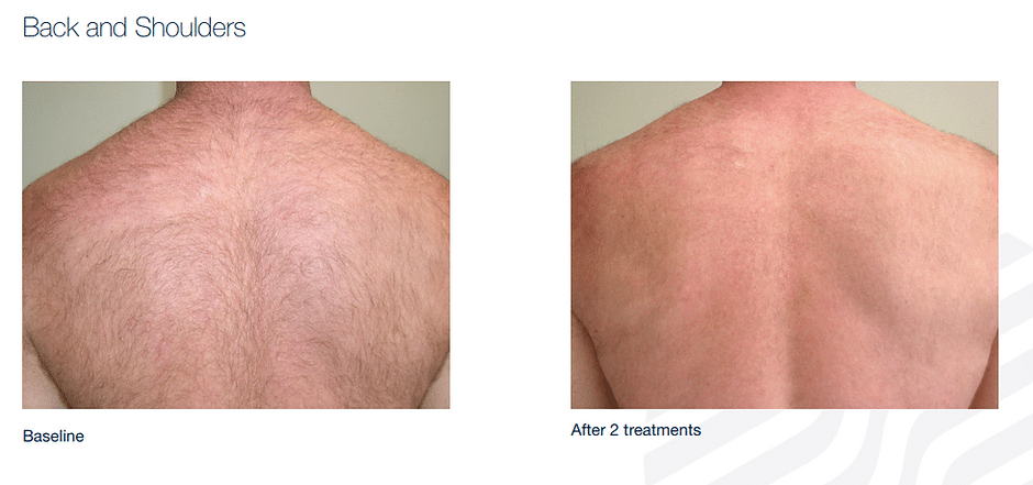 458e0d_a58bd37aece24f51a73d73a05efa1363mv2 Laser Hair Removal in Sandy, UT