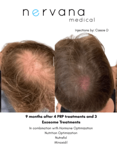 Hair Restoration in Sandy, UT