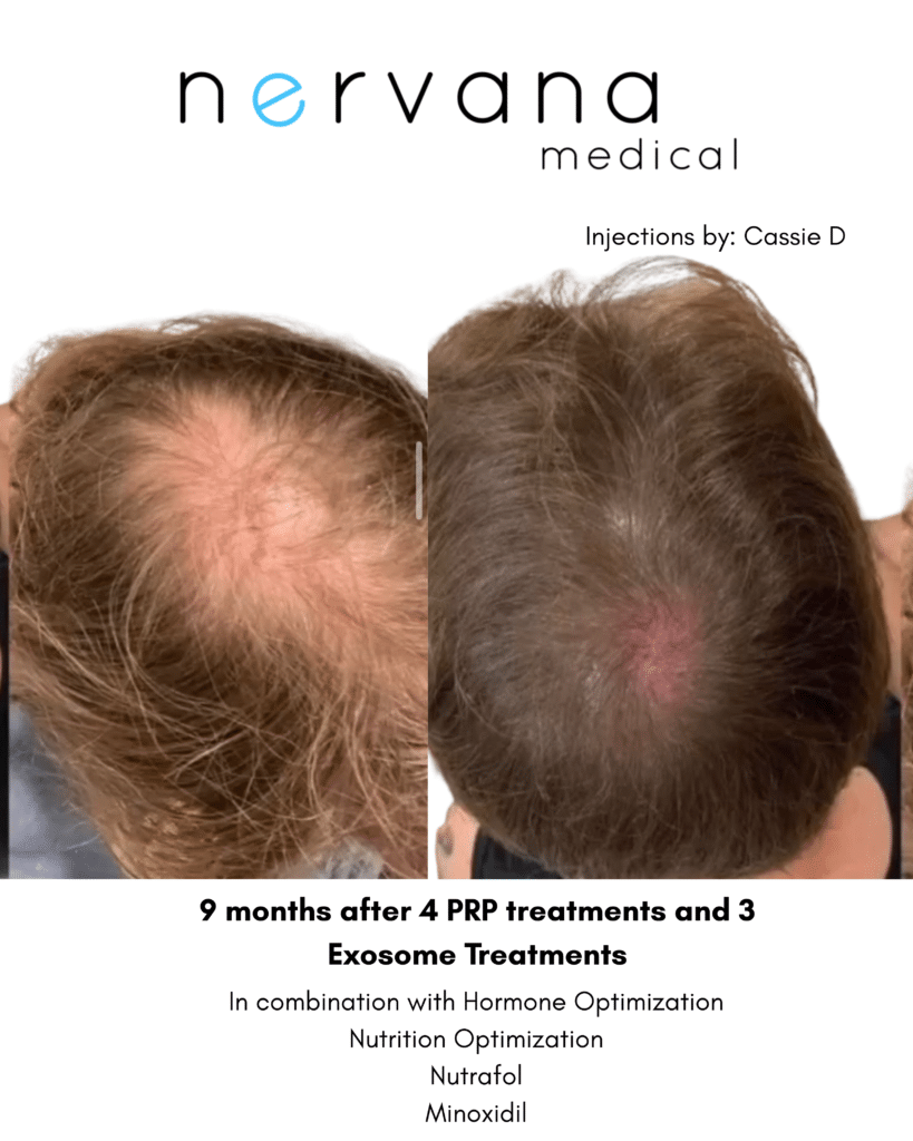 Hair Restoration in Sandy, UT
