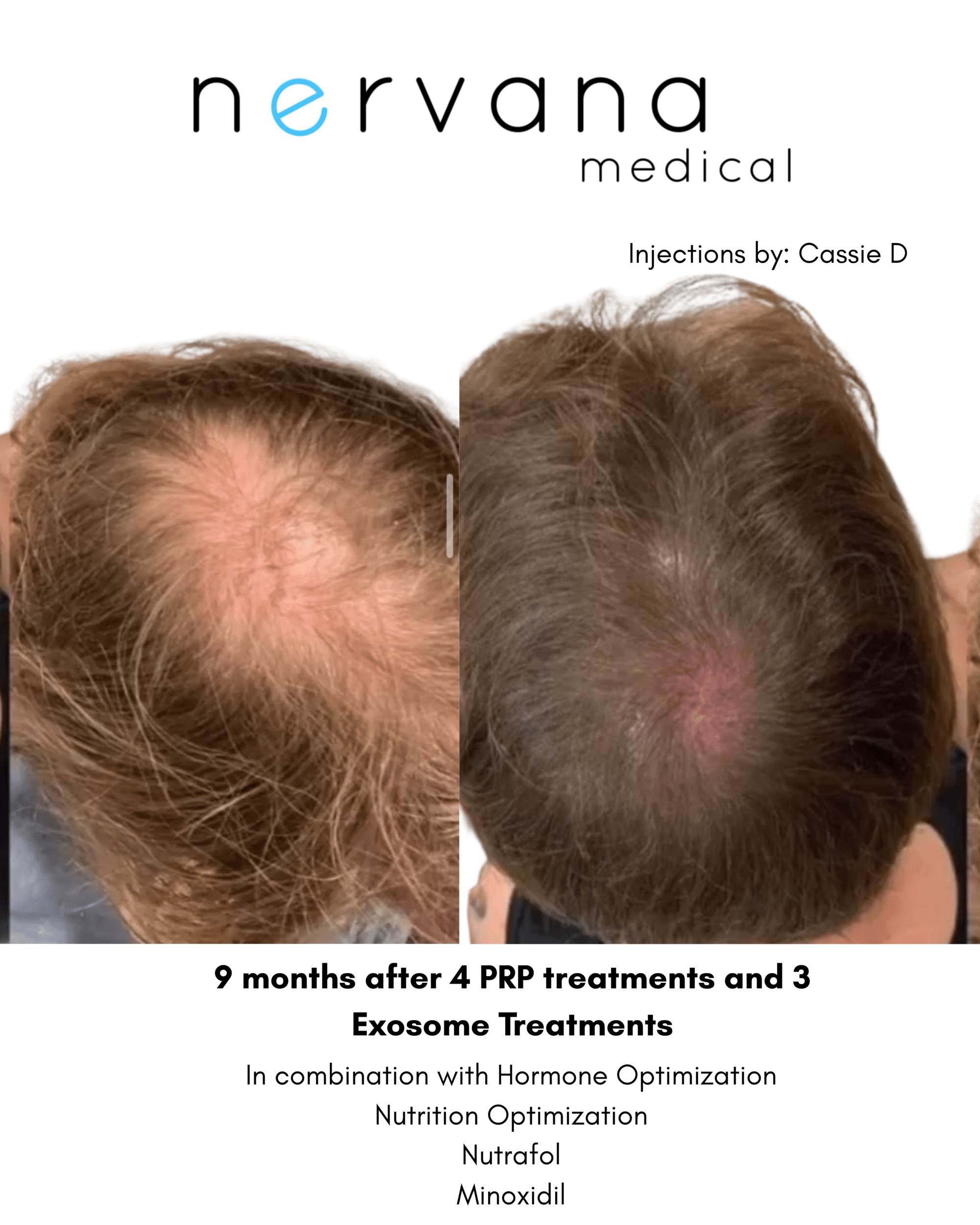 Before and After Image: PRP with Exosomes - back