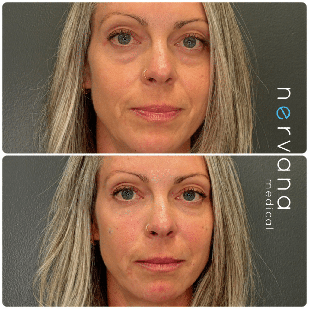 Before and After Image: Aesthetic Injectables - front