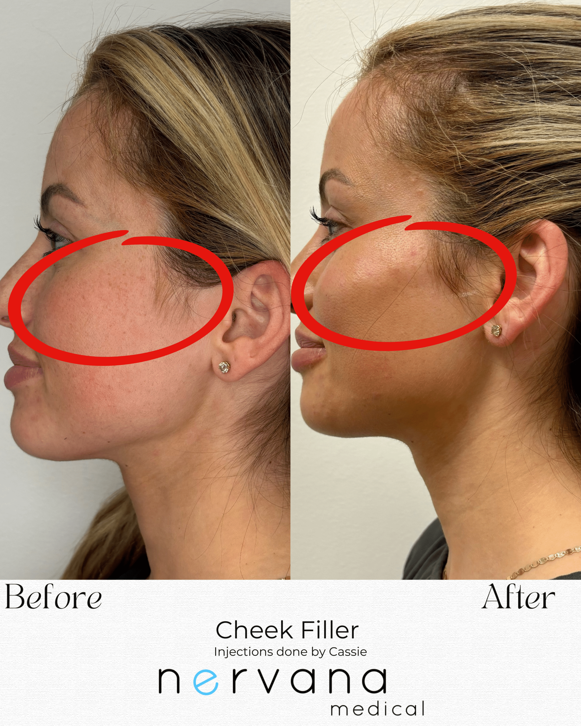 Before and After Image: Cheek Filler - left-side