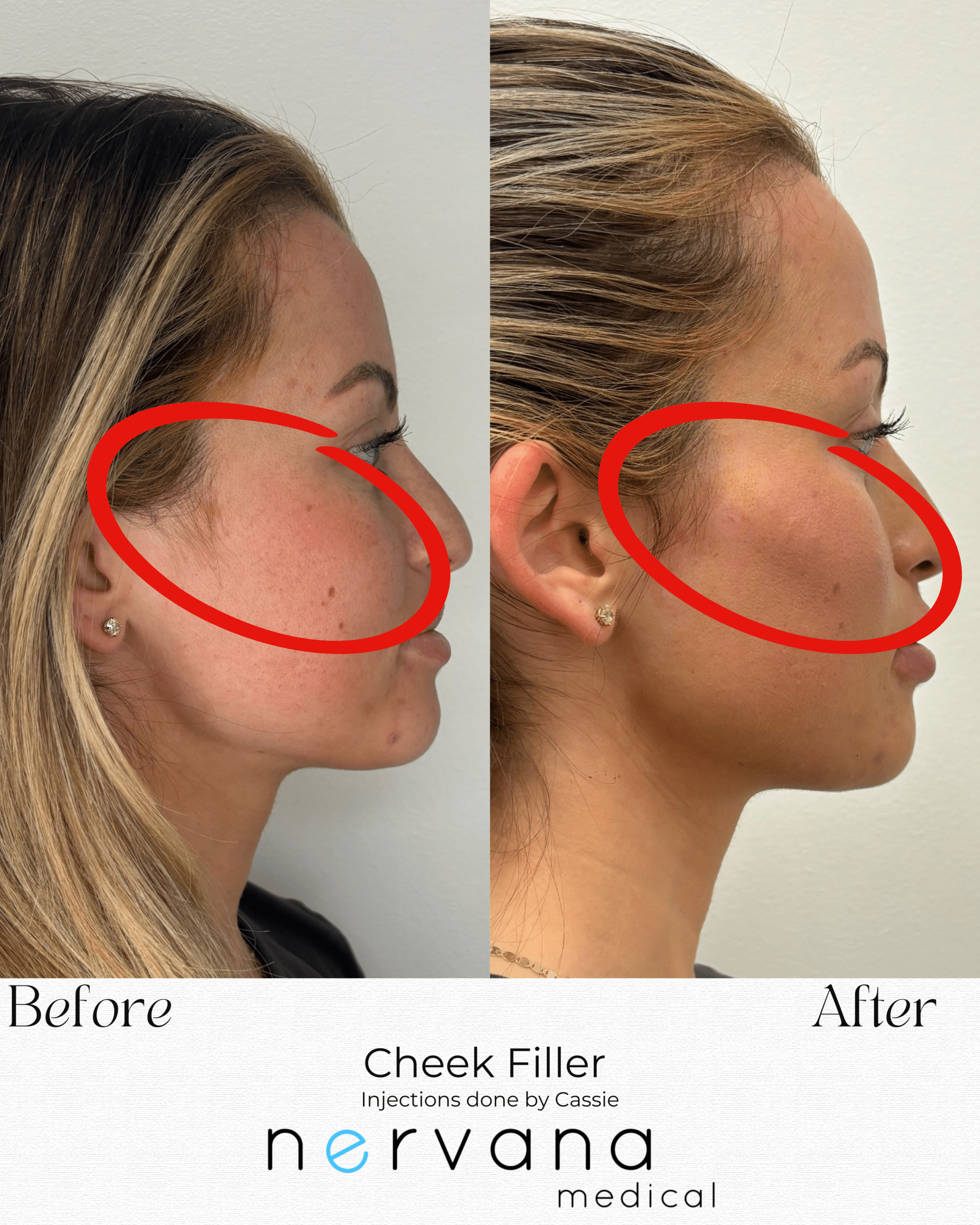 Before and After Image: Cheek Filler - right-side