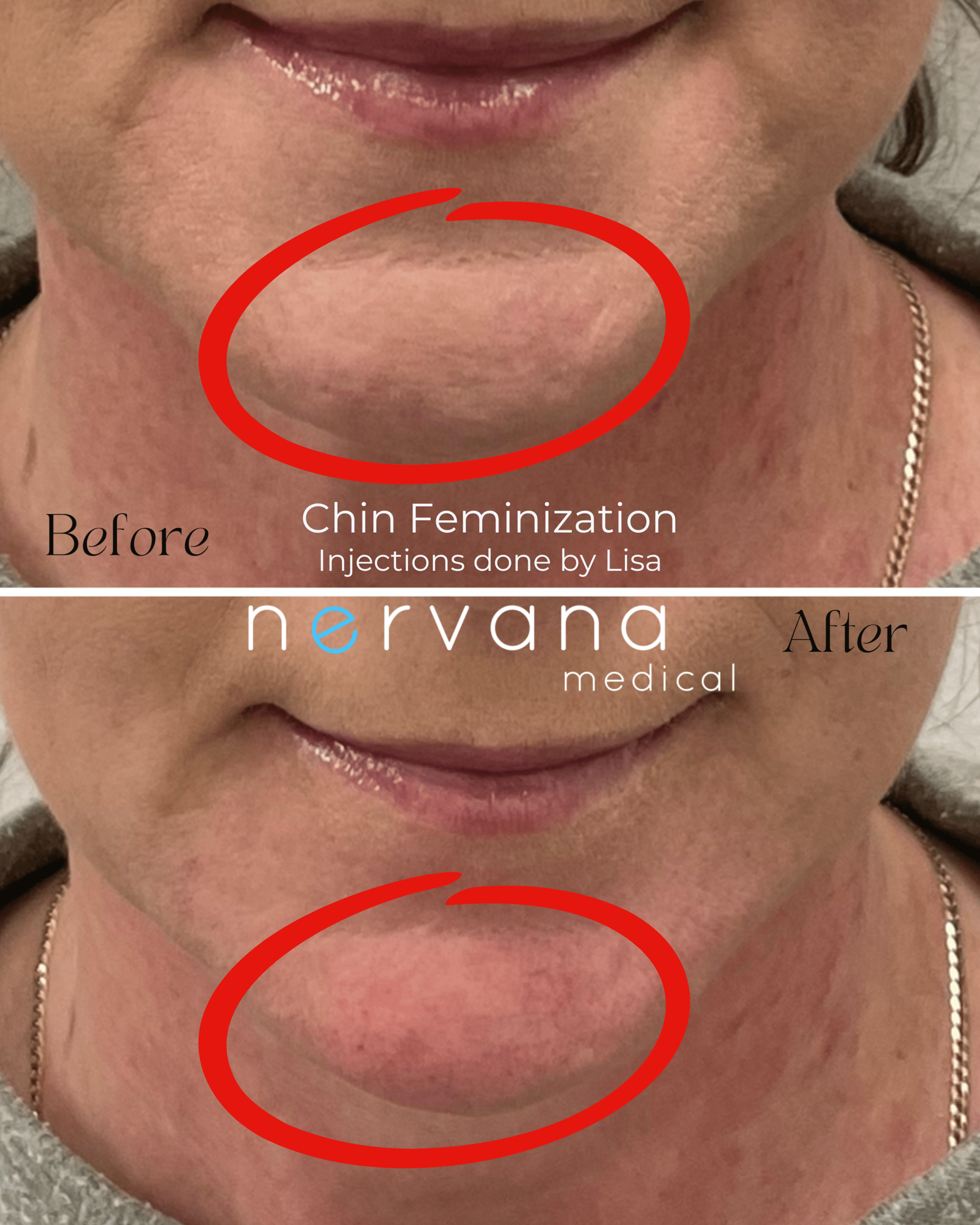 Before and After Image: Chin Feminization - front