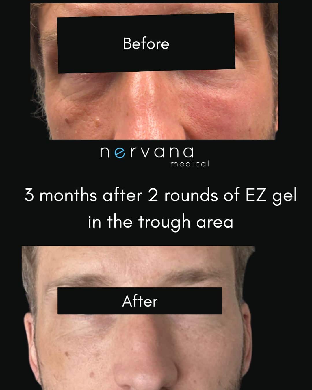Before and After Image: EZ Gel – Tear Trough - front