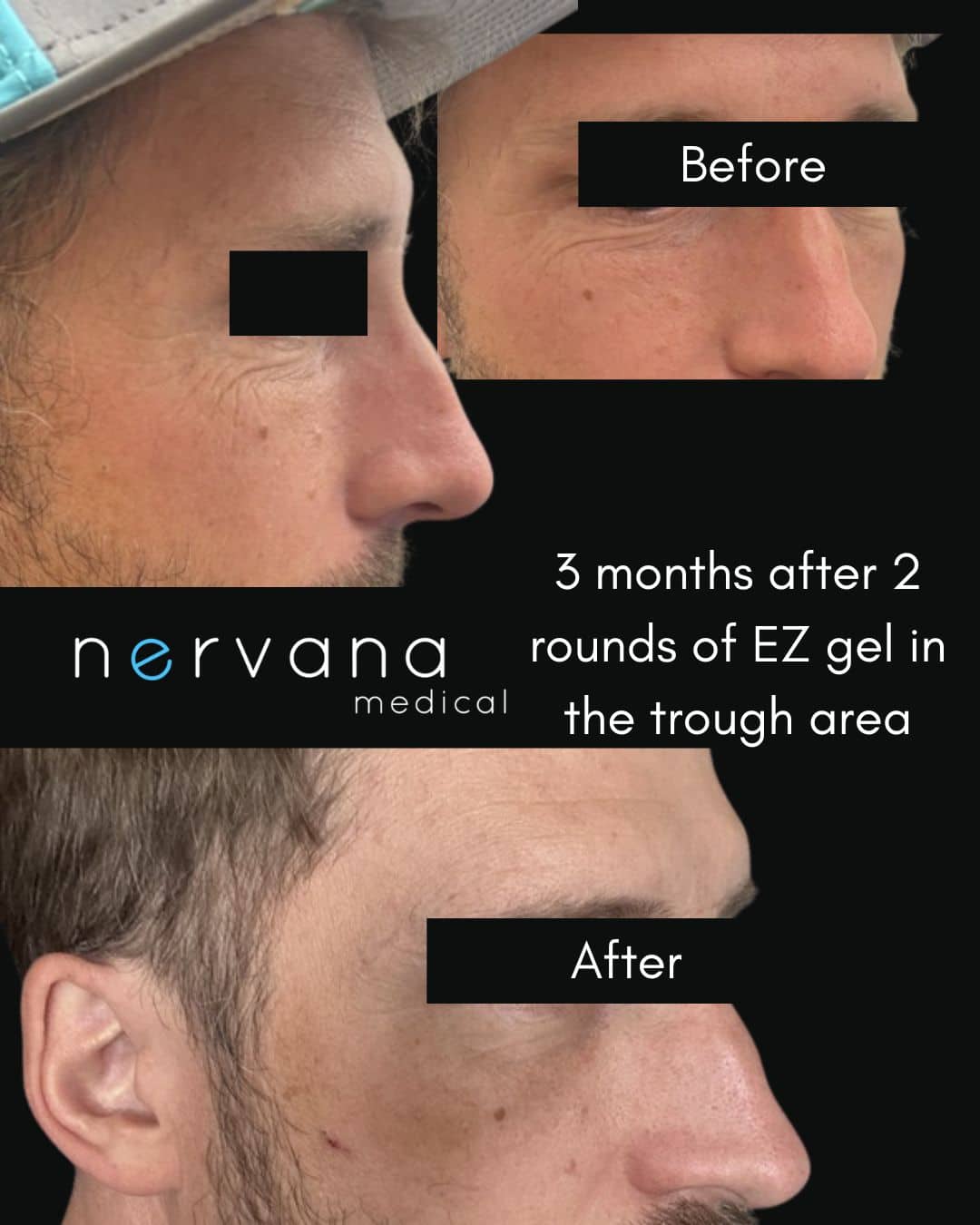 Before and After Image: EZ Gel and HA Dermal Filler - right-front-oblique