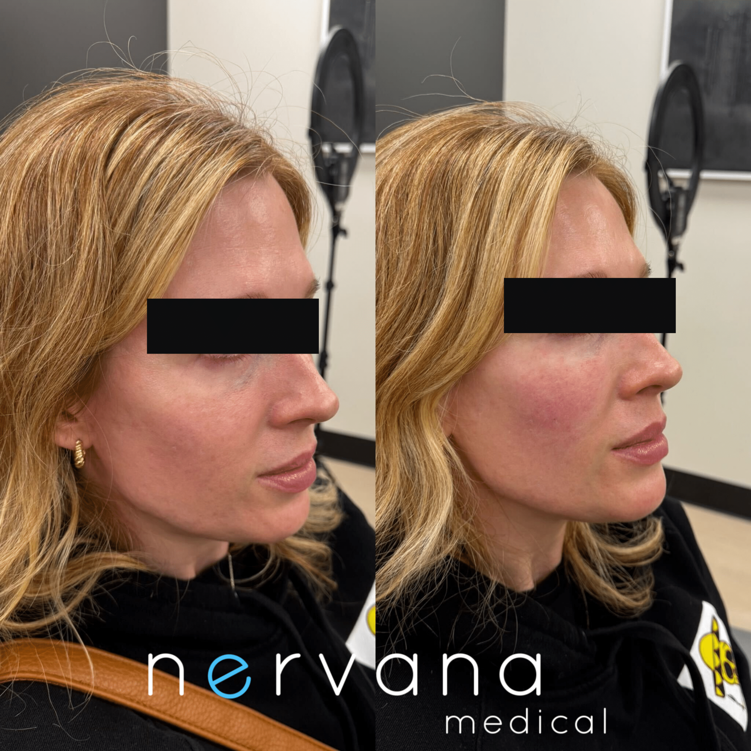 Before and After Image: EZ Gel – Undereyes - right-front-oblique