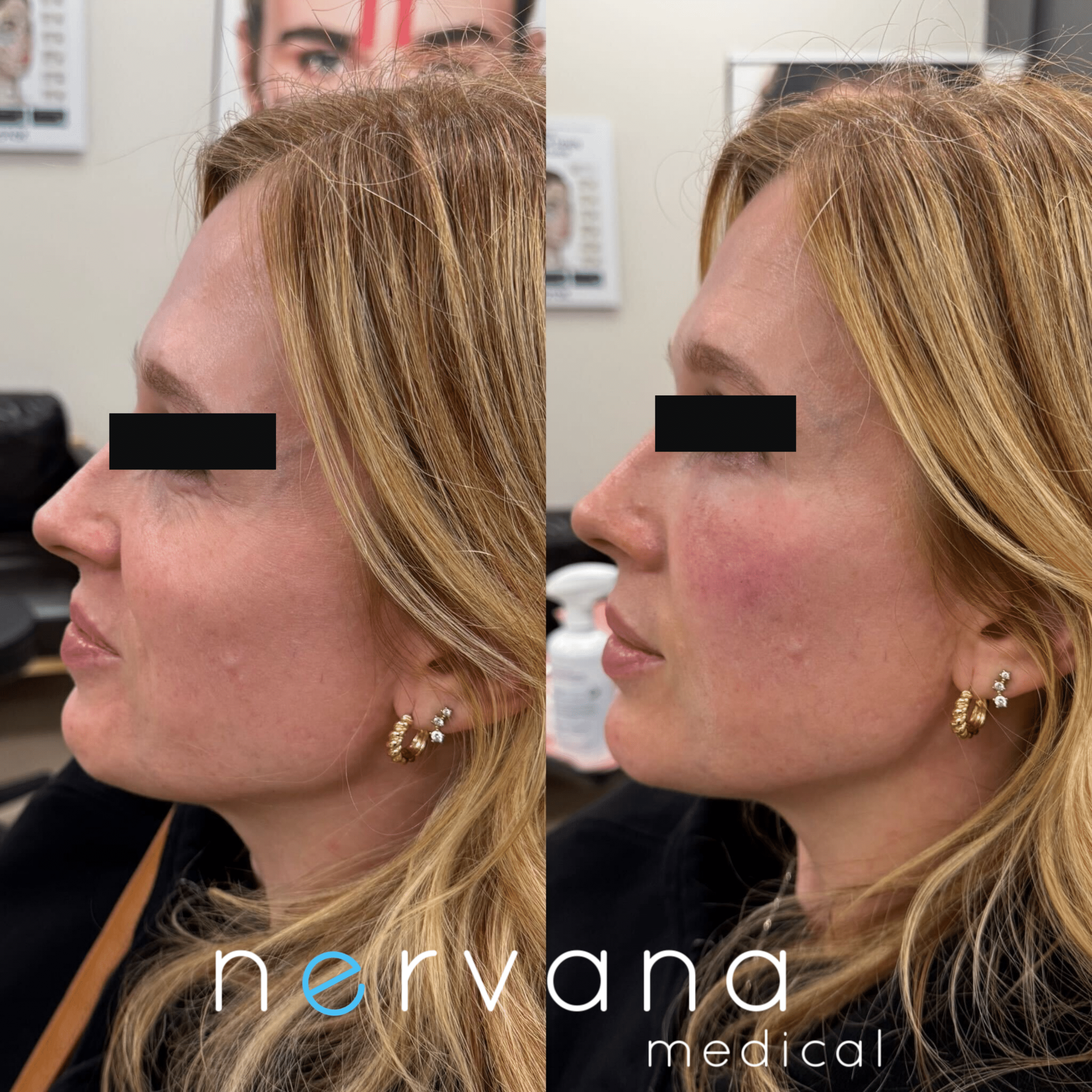 Before and After Image: EZ Gel – Undereyes - left-side
