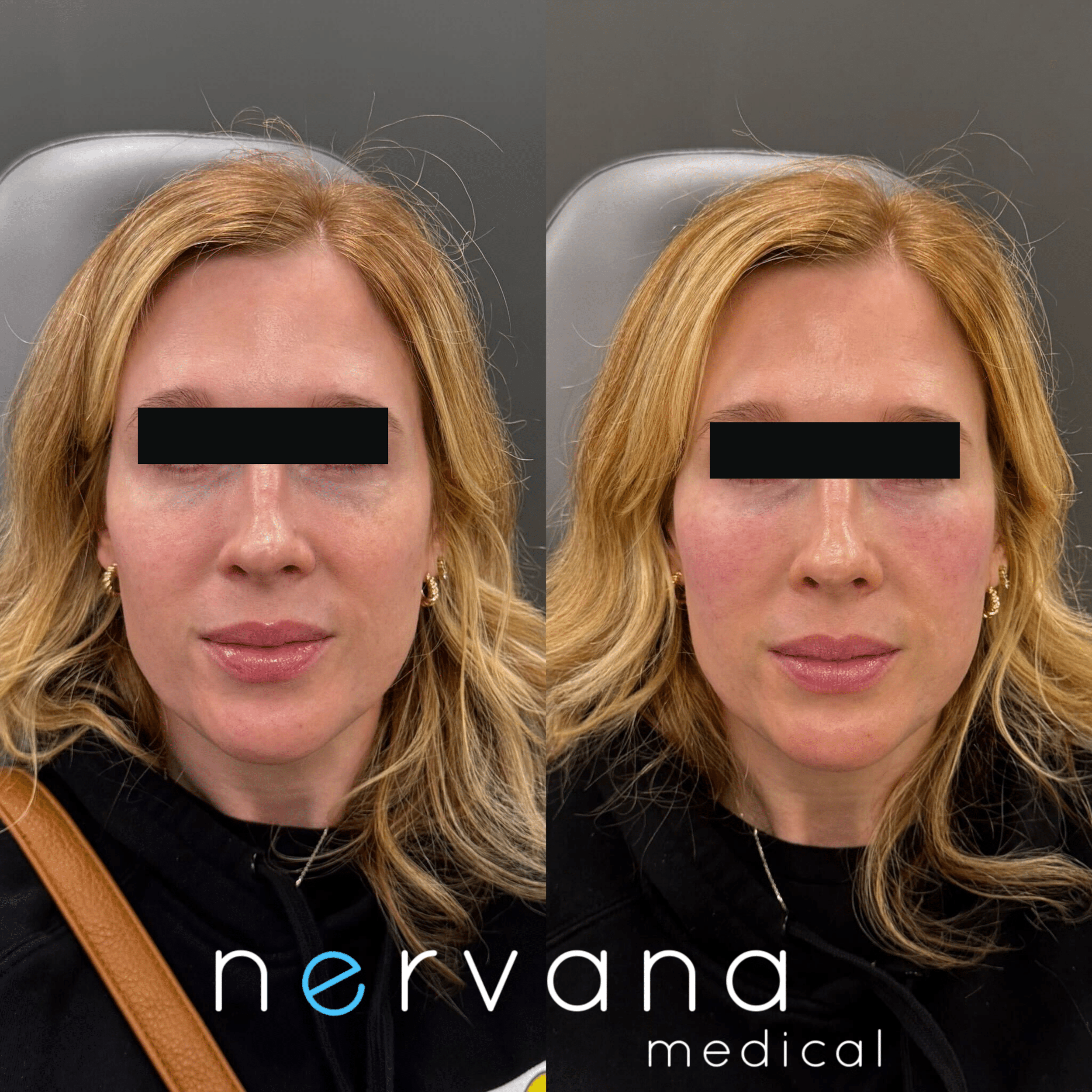 Before and After Image: EZ Gel – Undereyes - front