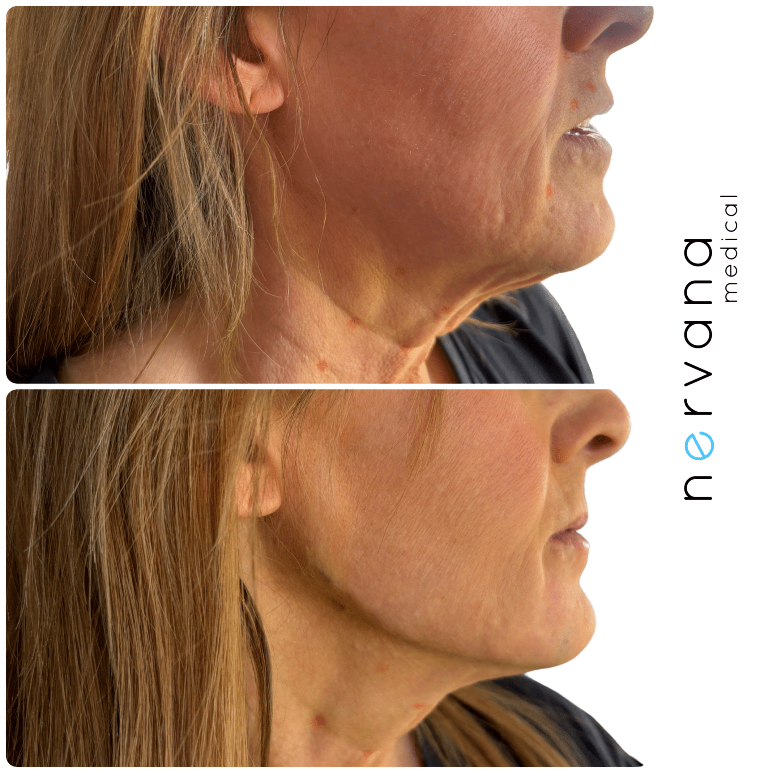 Before and After Image: Facial Rejuvenation with Radiesse - right-side