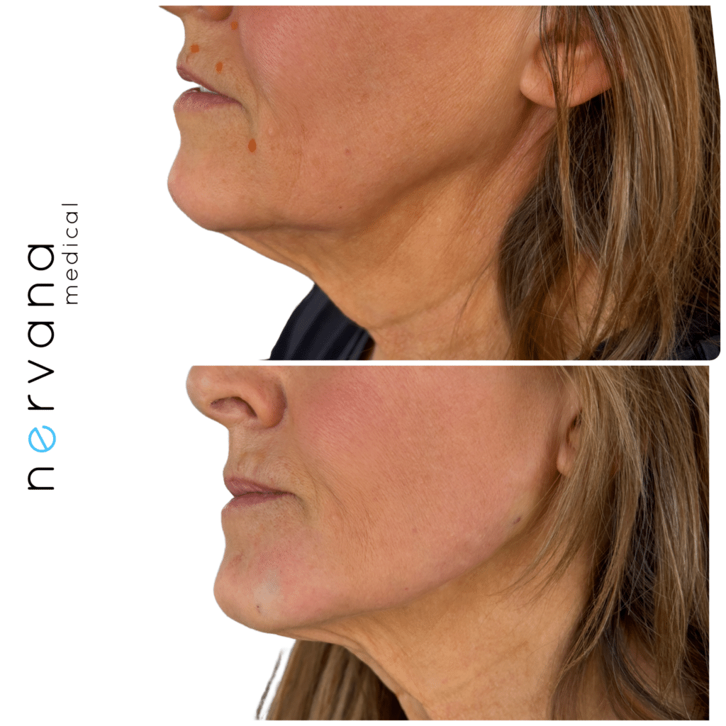 Before and After Image: Facial Rejuvenation with Radiesse - left-side