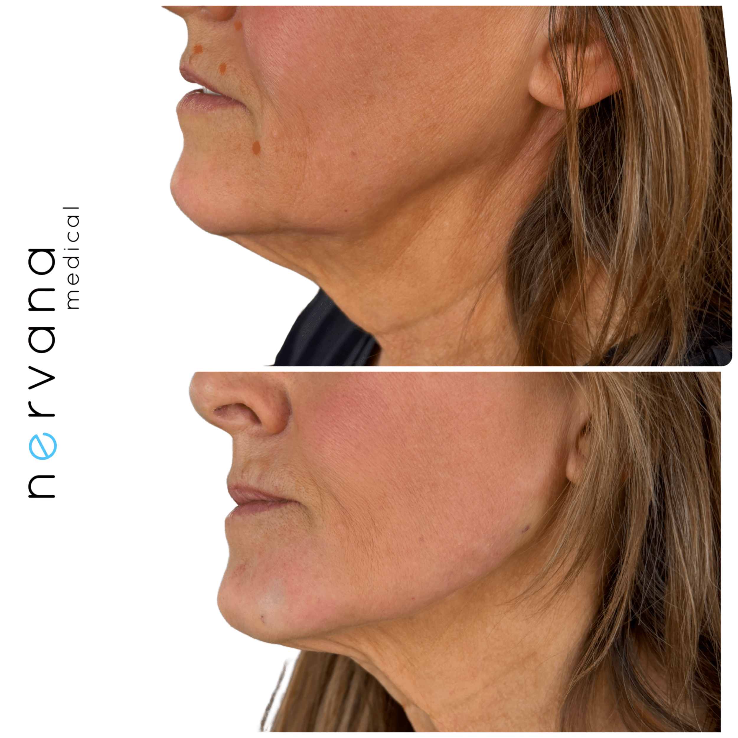 Before and After Image: Facial Rejuvenation with Radiesse - left-side