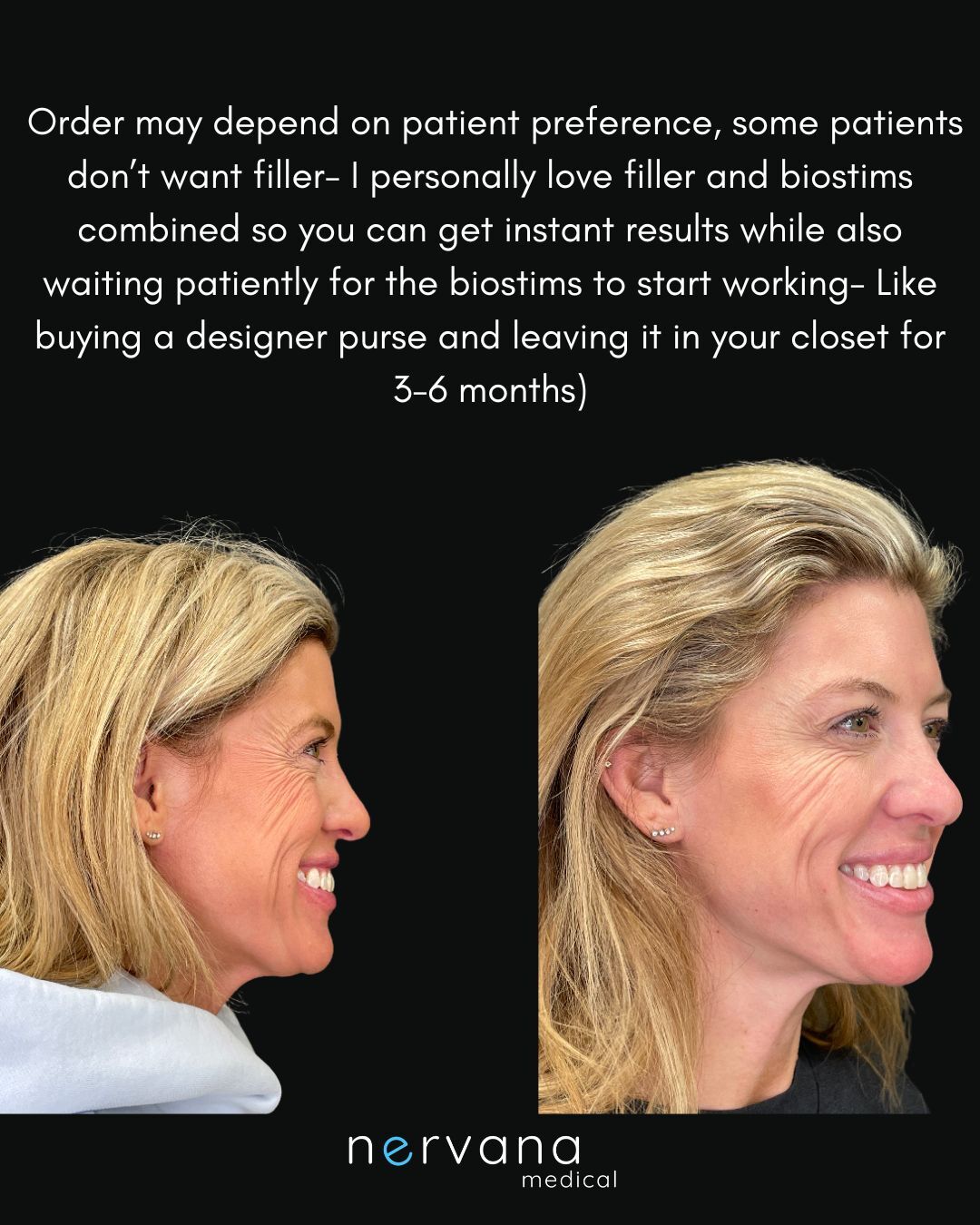 Before and After Image: Filler and Biostims Combined - right-front-oblique