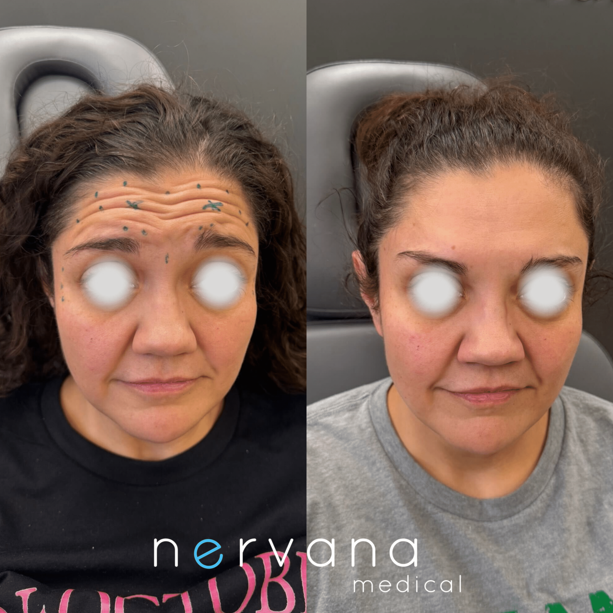 Before and After Image: Neuromodulators – Forehead and Glabella - front