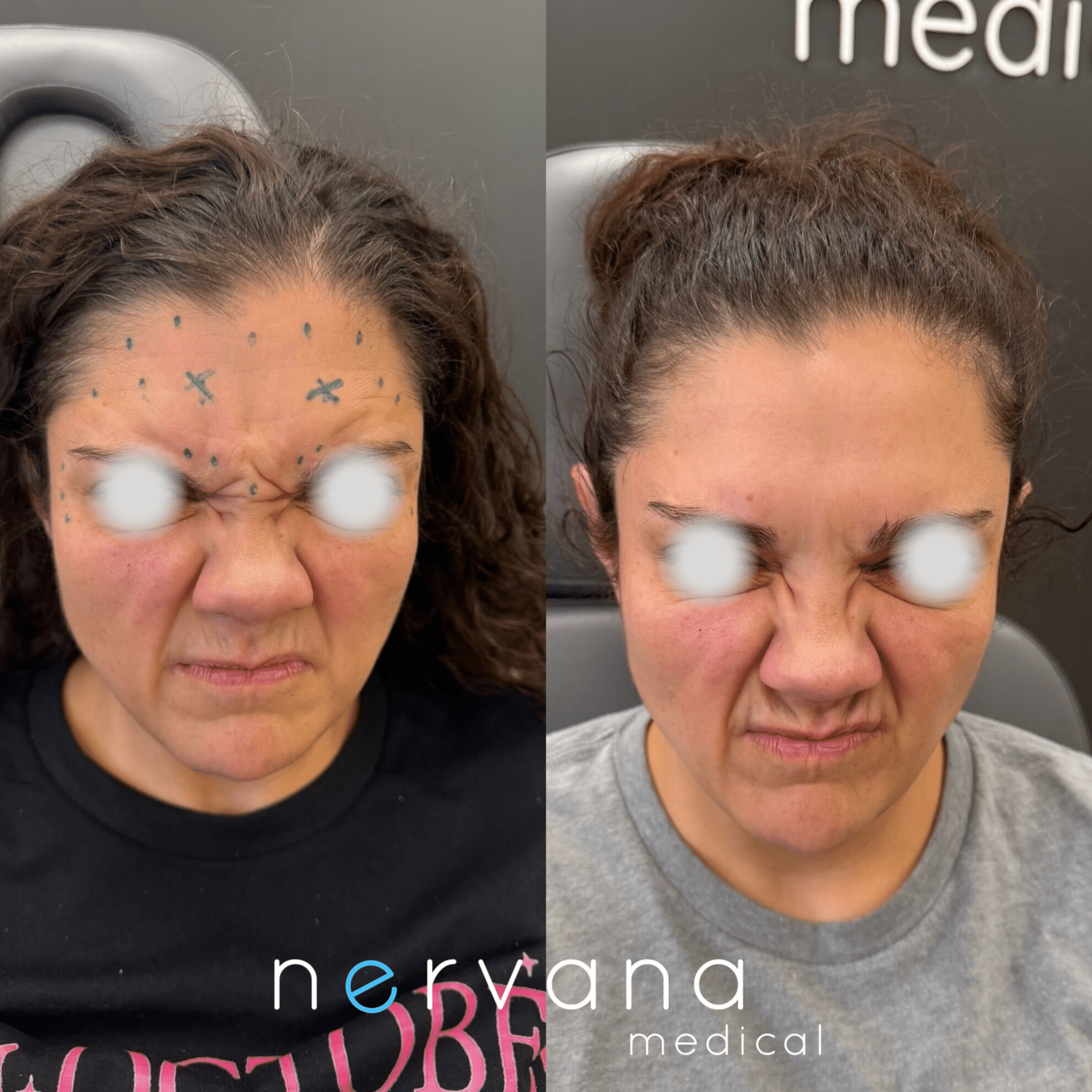Before and After Image: Neuromodulators – Forehead and Glabella - front