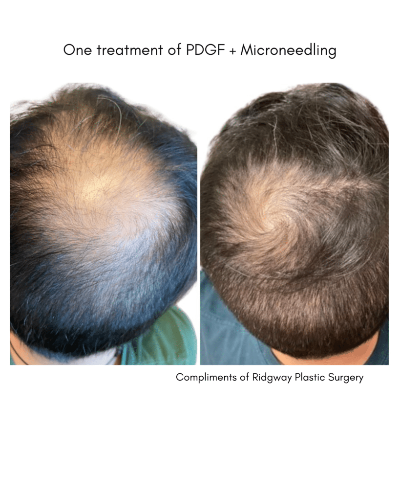 Before and After Image: PDGF + Microneedling - back