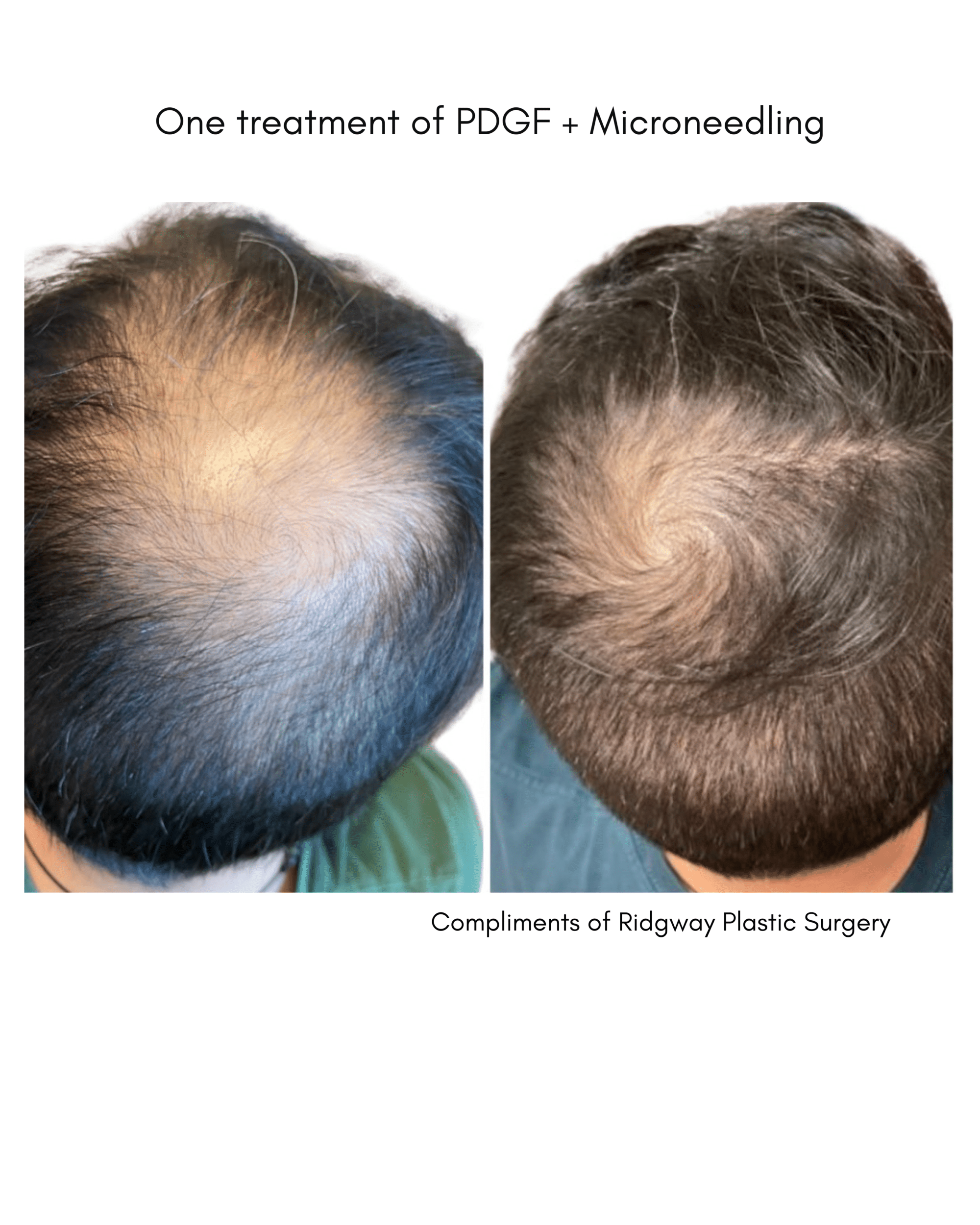 Before and After Image: PDGF + Microneedling - back