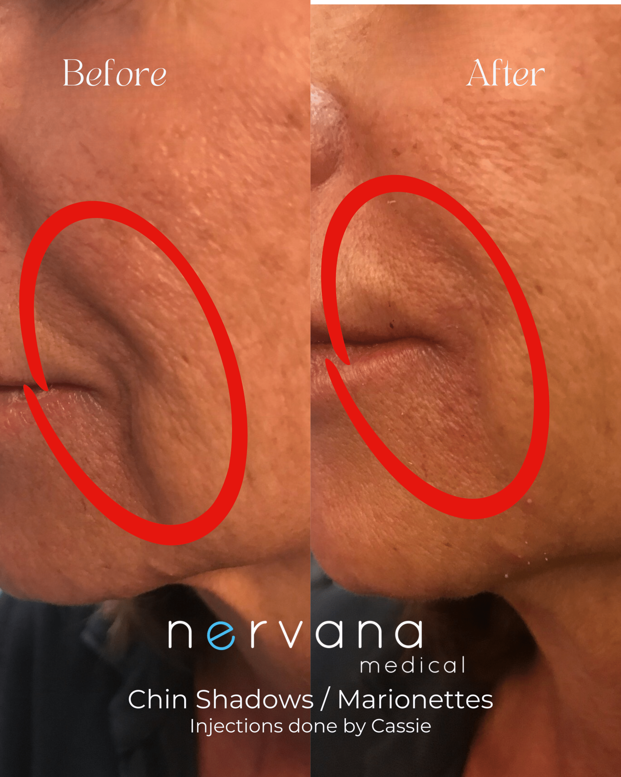 Before and After Image: Chin Shadows/Marionettes - left-front-oblique