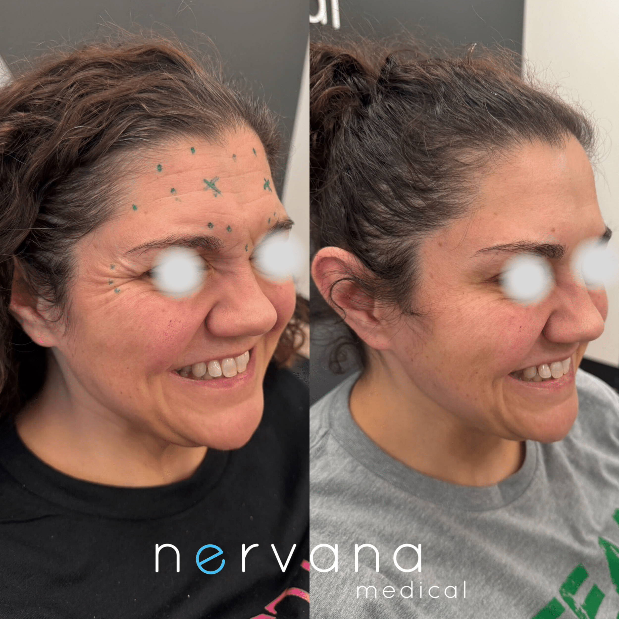 Before and After Image: Crow’s Feet with Neuromodulators - right-front-oblique