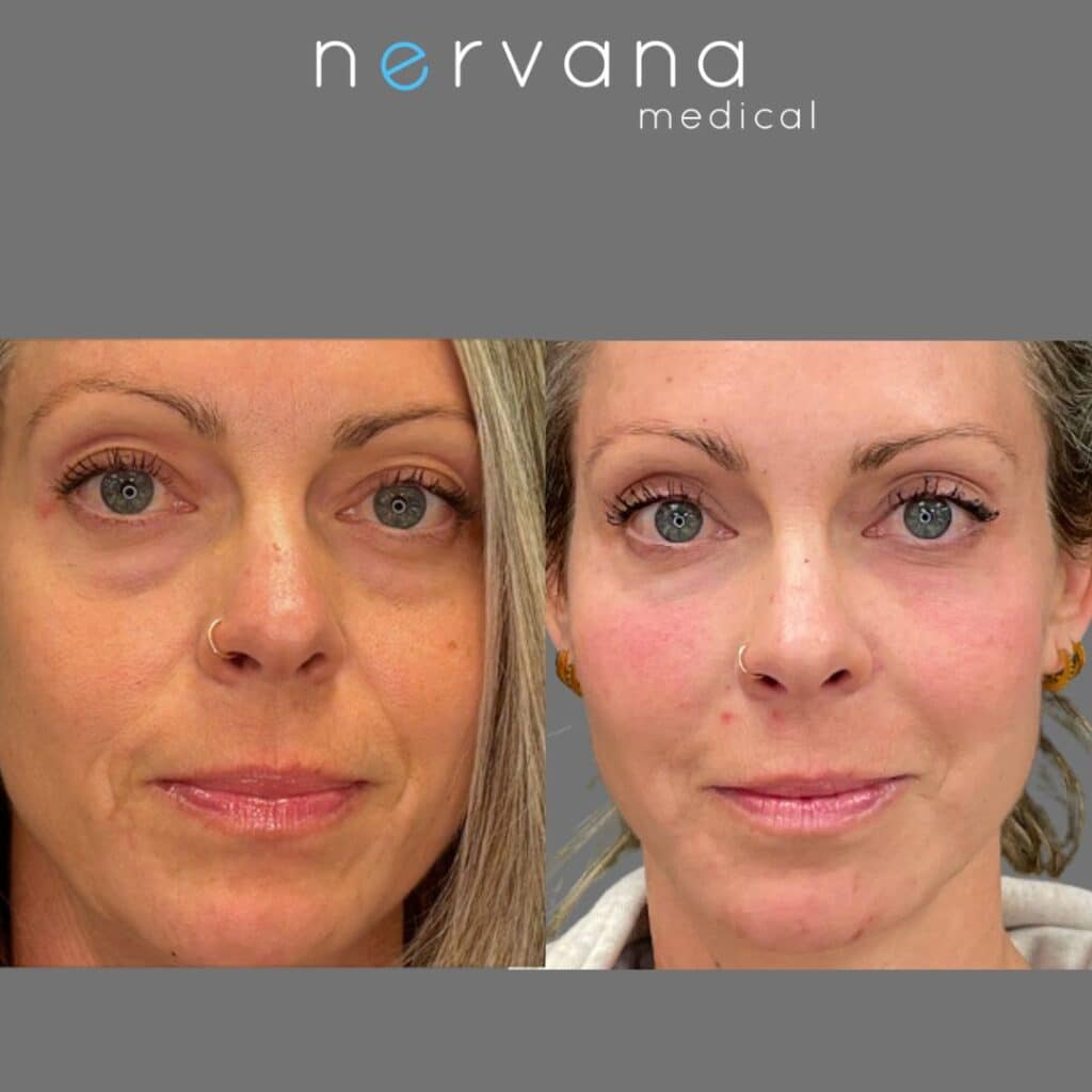 Tear Trough Fillers in Sandy, UT