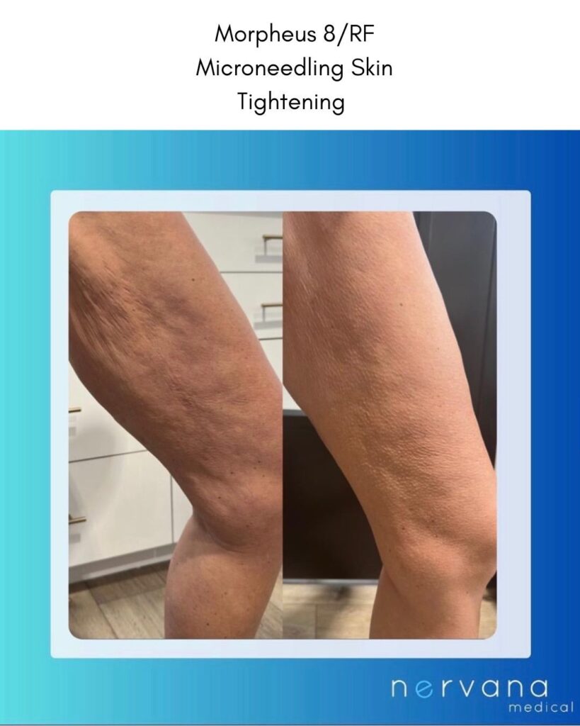 Morpheus - RF Microneedling in Sandy, UT