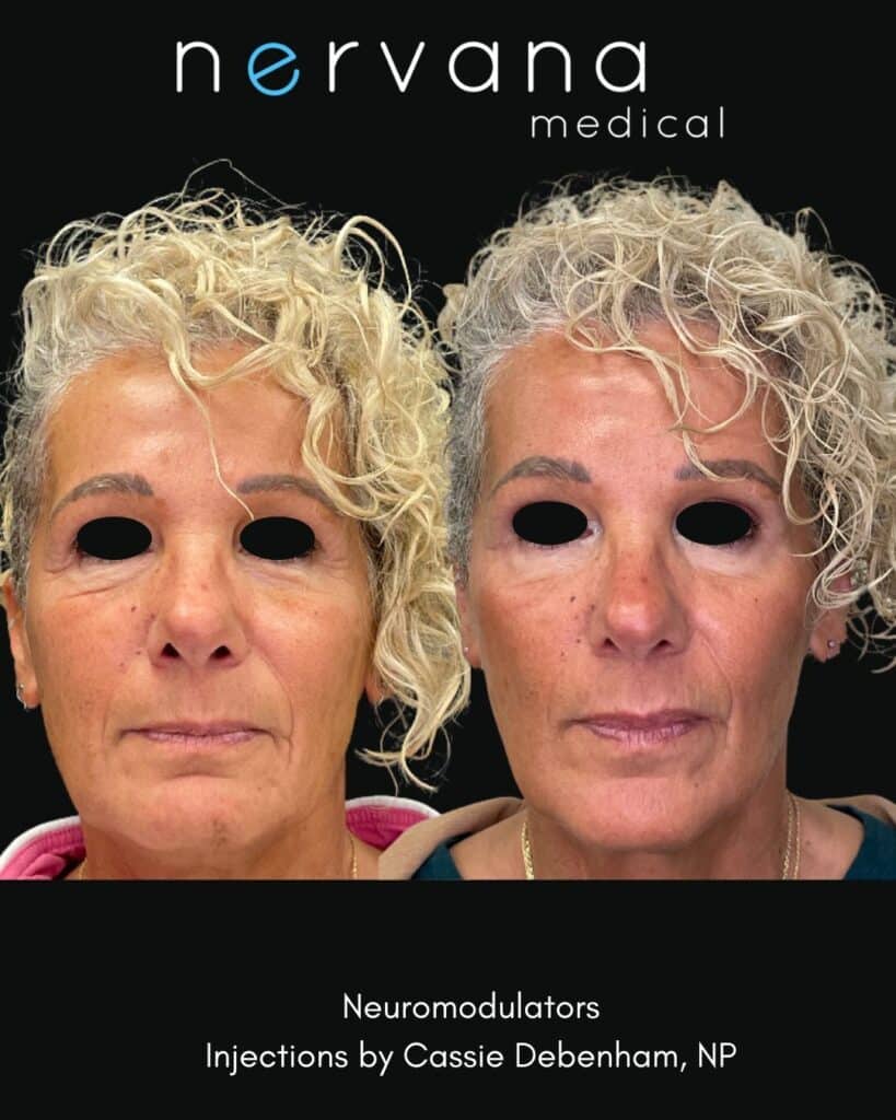 Botox/Dysport in Sandy, UT
