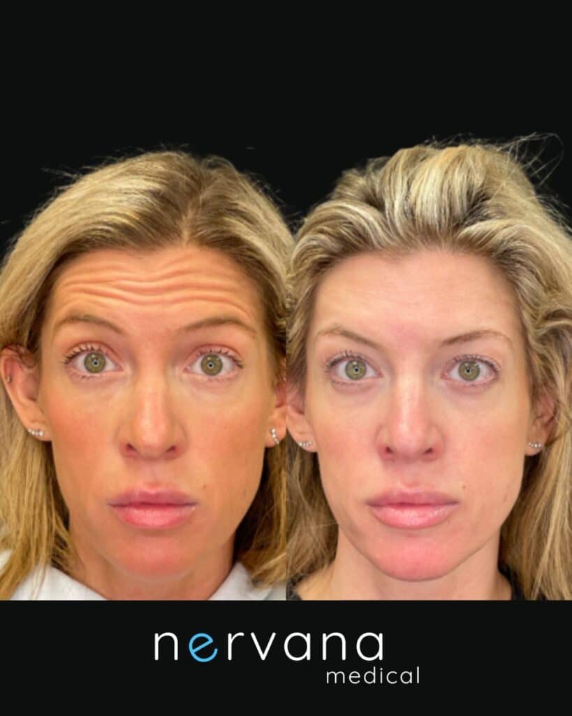 Botox/Dysport in Sandy, UT