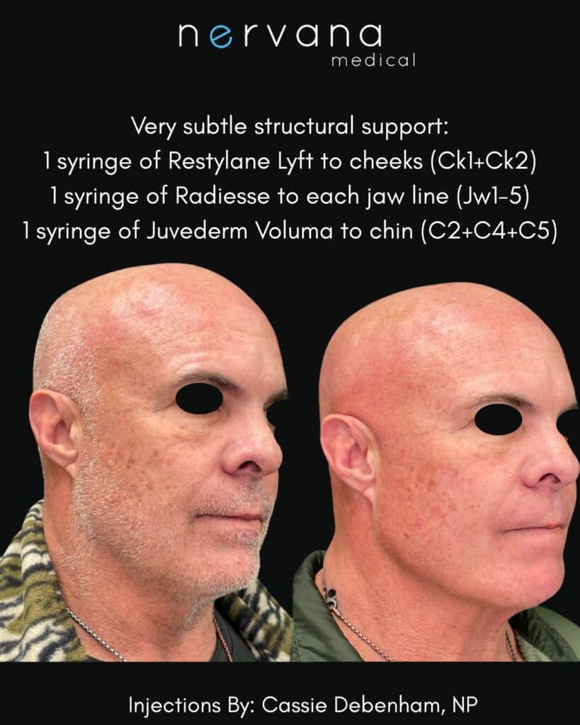 Before and After Image: Masculine Injections - front