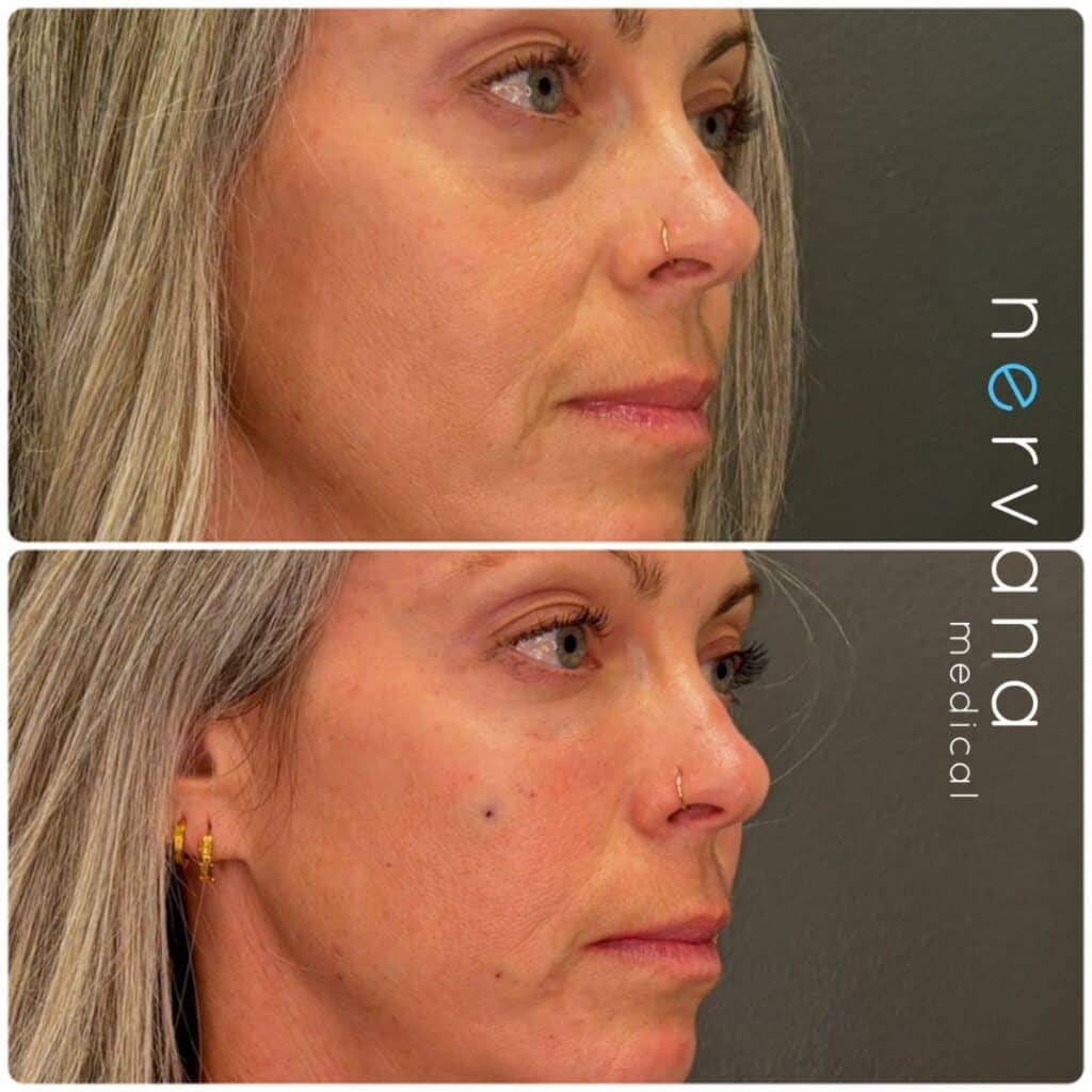 Before and After Image: Troughs - right-front-oblique