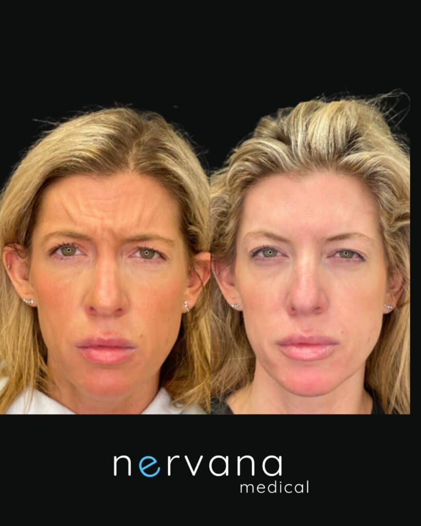 Before and After Image: Neuromodulators-Jeuveau - front