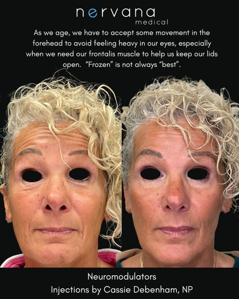 Before and After Image: Full Face Neuromodulators - front